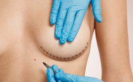 Augmentation mammaire à Paris : transformez votre silhouette !